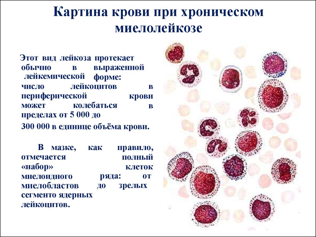 Изменение клеток крови. Картина периферической крови при хроническом лейкозе. Хронический миелолейкоз картина крови. Острый миелолейкоз картина крови. Миелоцитарный лейкоз картина крови.