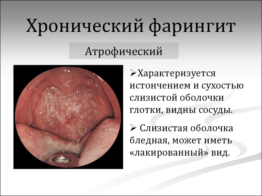 Фарингит клиническая картина