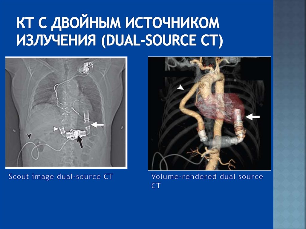 КТ С ДВОЙНЫМ ИСТОЧНИКОМ ИЗЛУЧЕНИЯ (DUAL-SOURCE CT)