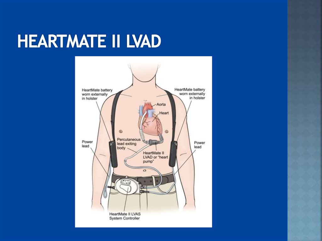 HEARTMATE II LVAD