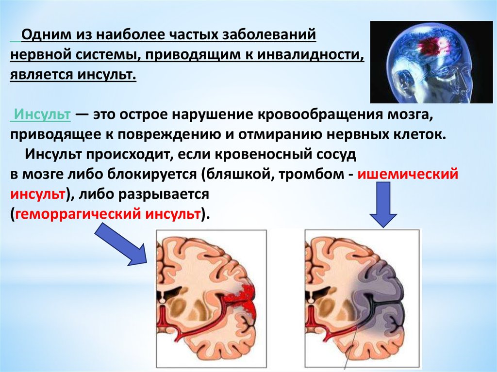 Болезнь отмирания мозга