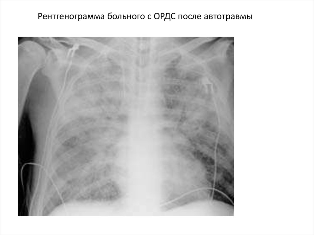 Уплотнение легкого при ордс связано. Респираторный дистресс синдром рентген. Респираторный дистресс синдром на рентгенограммах. Острый респираторный дистресс синдром рентген. Дистресс синдром легких рентген.