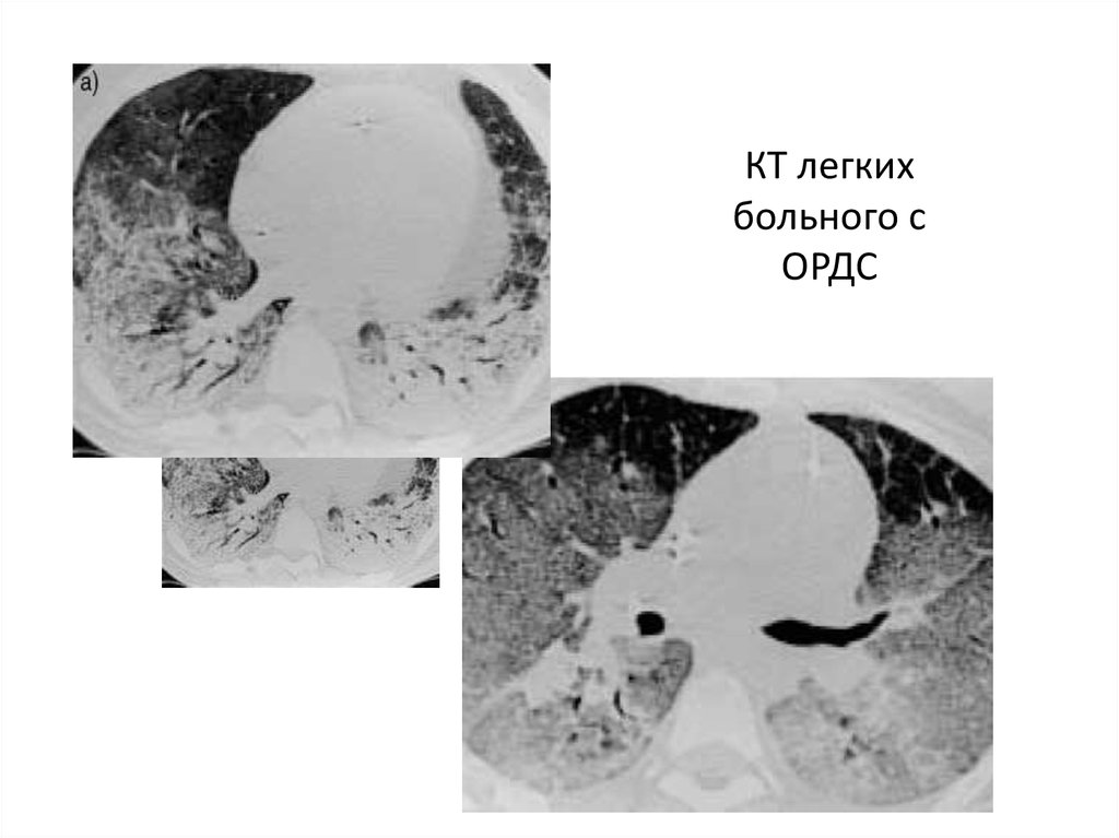 Отек легких на кт картинки