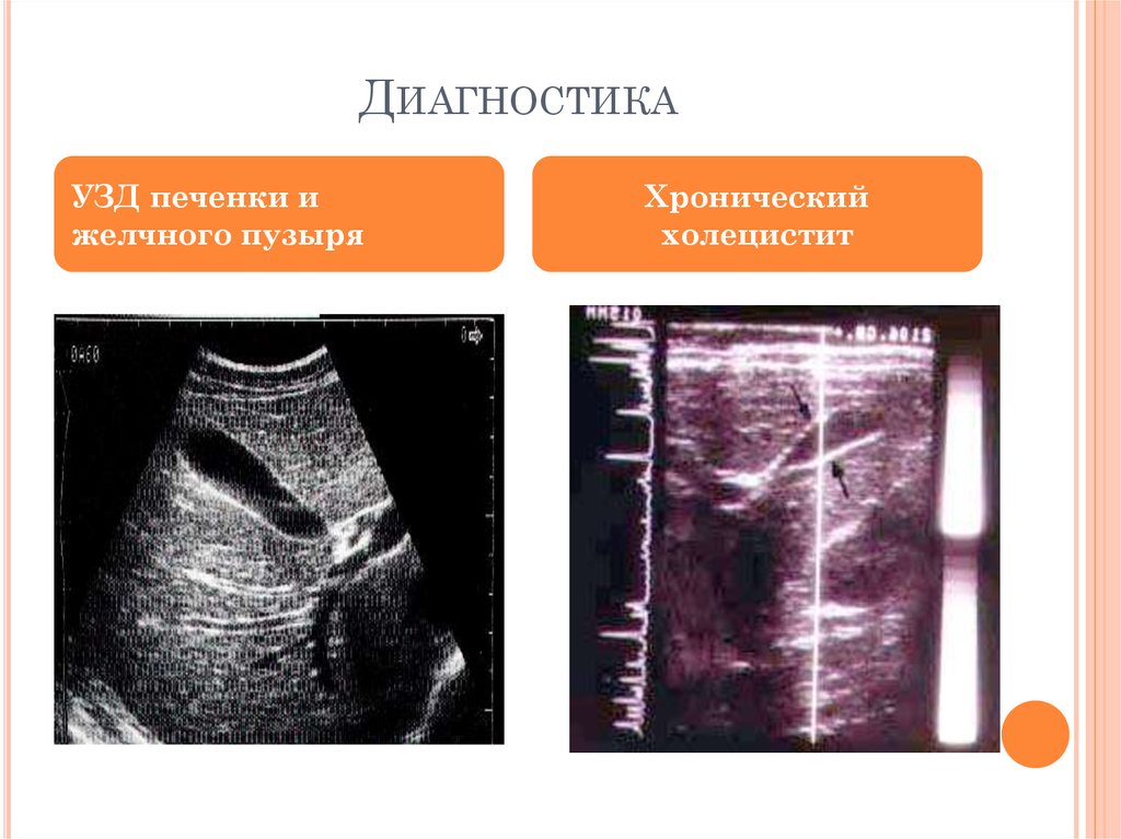 Хронический холецистит у пожилых людей презентация