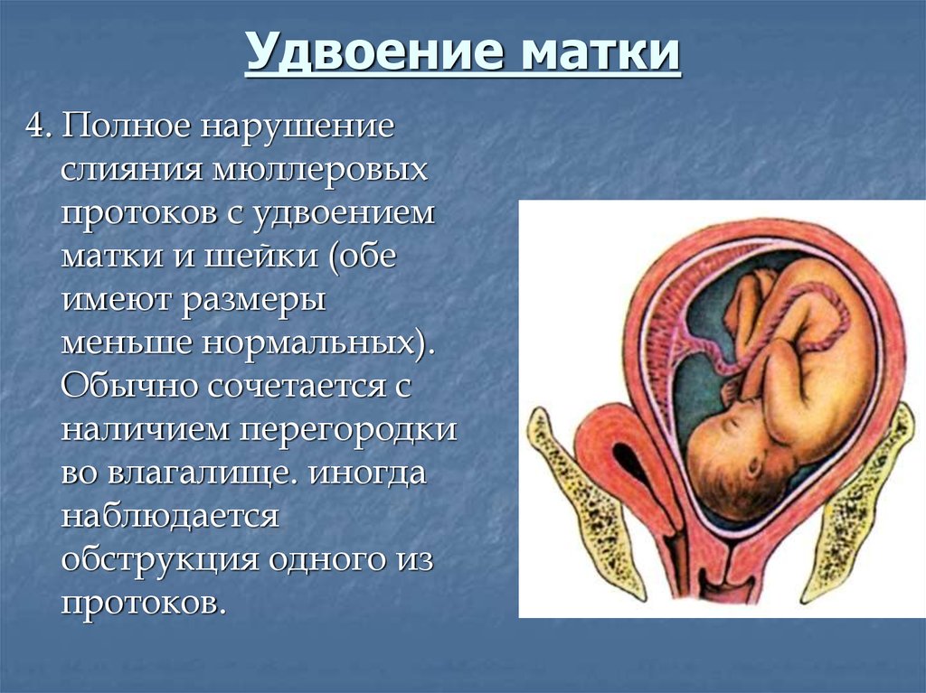 Две матки. Полное задвоение матки. Полное удвоение матки. Полное удвоение матки и шейки.