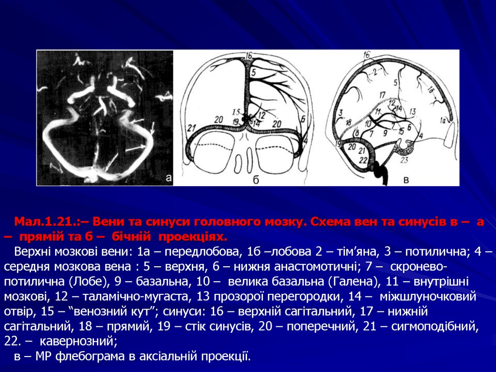 Аневризма синуса. Аневризма венозного синуса. Аневризма поперечного синуса.