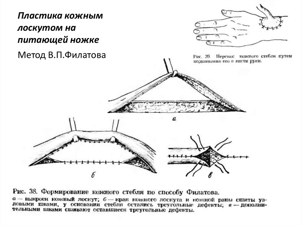 Кожная пластика кожным лоскутом. Пластика кожным лоскутом на питающей ножке. Филатов метод кожной пластики. Филатовский стебель этапы. Лоскут кожи на питающей сосудистой ножке.