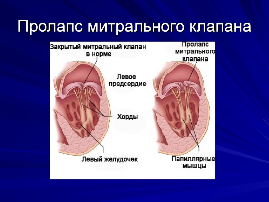 Пролапс митрального клапана аускультативная картина