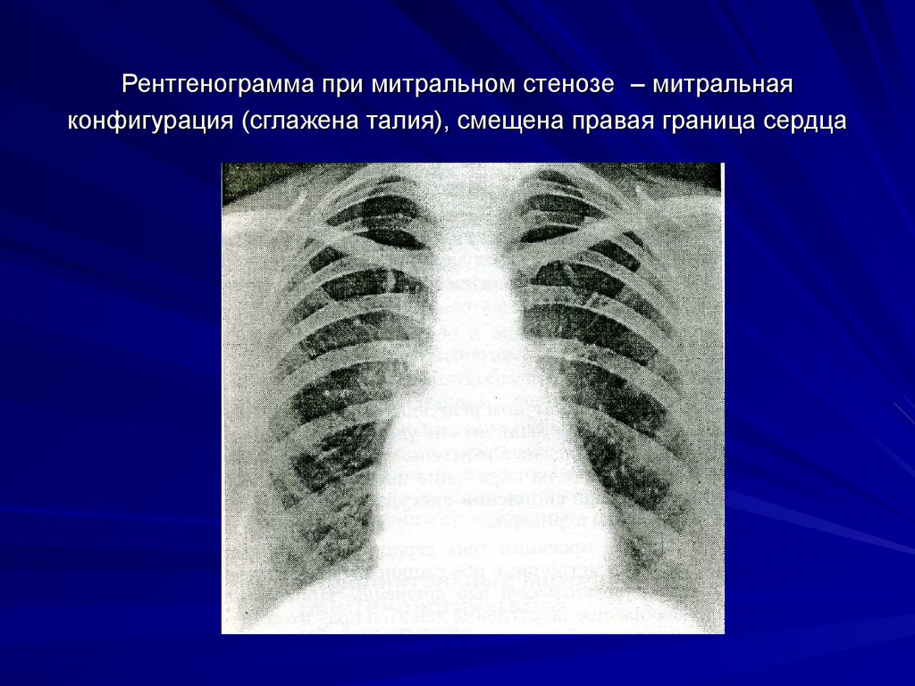 Рентгенограмма при митральном стенозе – митральная конфигурация (сглажена талия), смещена правая граница сердца
