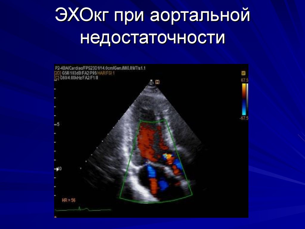 Аортальная сердечная недостаточность. Аортальная недостаточность Эхо. Аортальная недостаточность УЗИ. ЭХОКГ при приобретенных пороках сердца. Недостаточность аортального клапана ЭХОКГ.