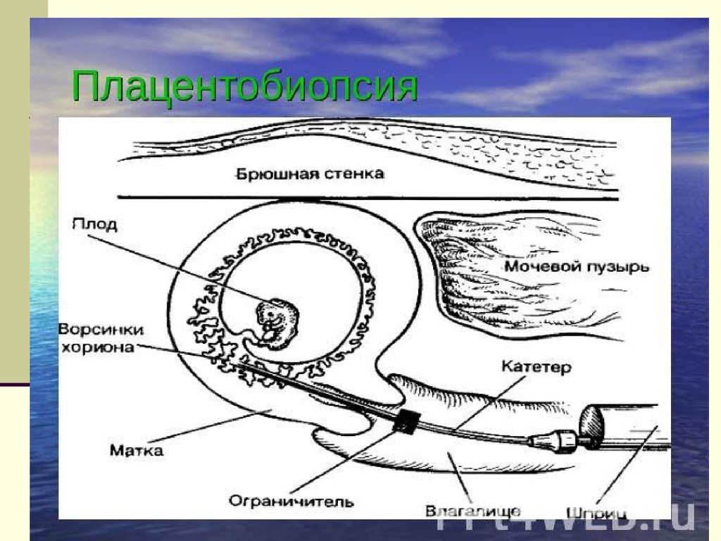Стенки плода. Хорионбиопсия плацентобиопсия. Хорион и плацентобиопсия. Плацентобиопсия сущность метода.