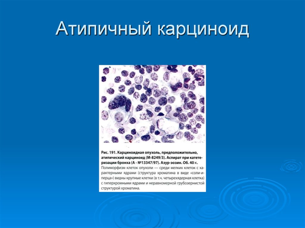 Атипичные клетки в цитологии что это. Злокачественный карциноид гистология. Адено карциноидная опухоль. Карциноид гистологическая картина.