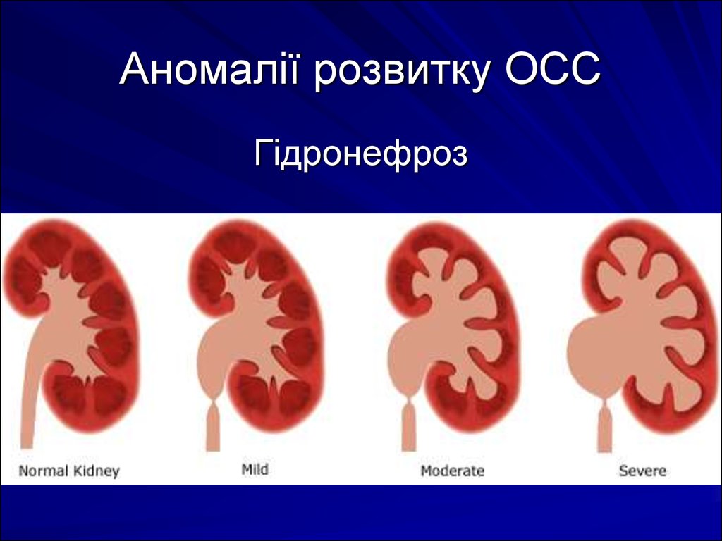 Каликоэктазия почек. Причины развития гидронефроза у детей. Врожденный гидронефроз у детей клинические рекомендации. Гидронефроз у детей клинические рекомендации.