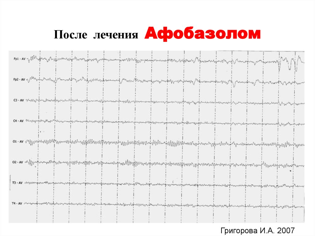 Пароксизмальные состояния в неврологической практике - online presentation