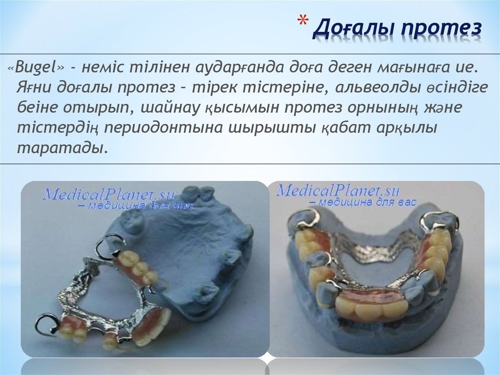 Дробители нагрузки бюгельного протеза. Части бюгельного протеза. Бюгельные протезы презентация. Опирающиеся протезы (бюгельные и съемные мостовидные).