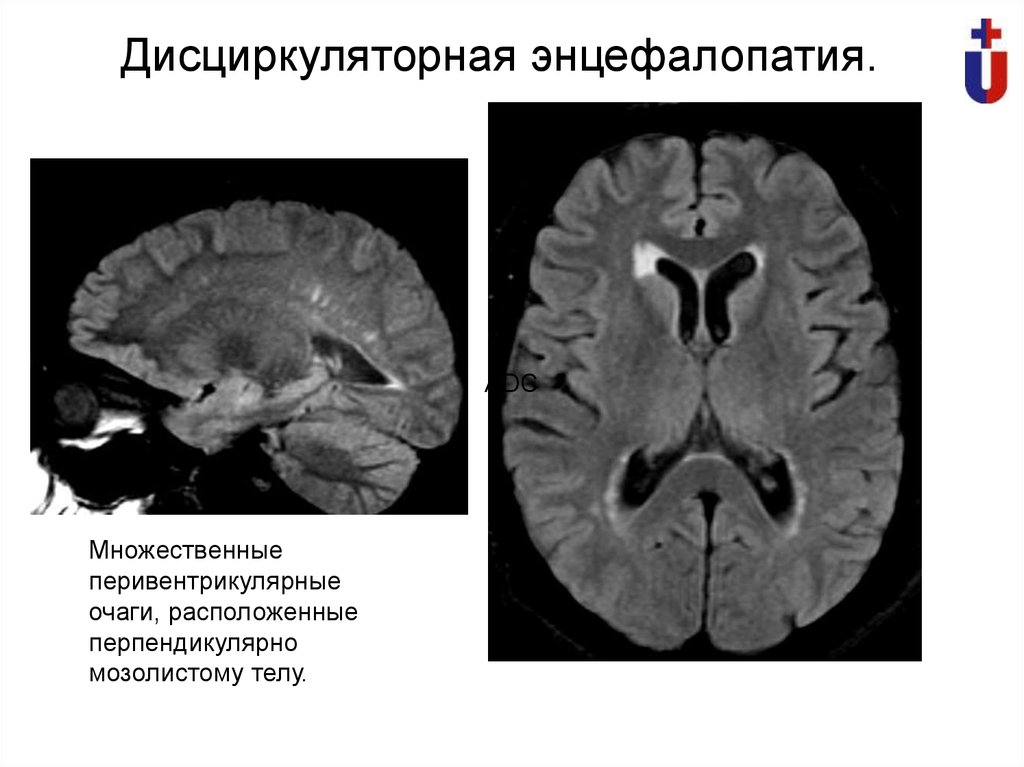 Дисциркуляторные изменения головного мозга что это такое. Дисциркуляторная энцефалопатия головного мозга на кт. Энцефалопатия на мрт очаги. Гипертоническая энцефалопатия мрт. Дисциркуляторная энцефалопатия мрт.