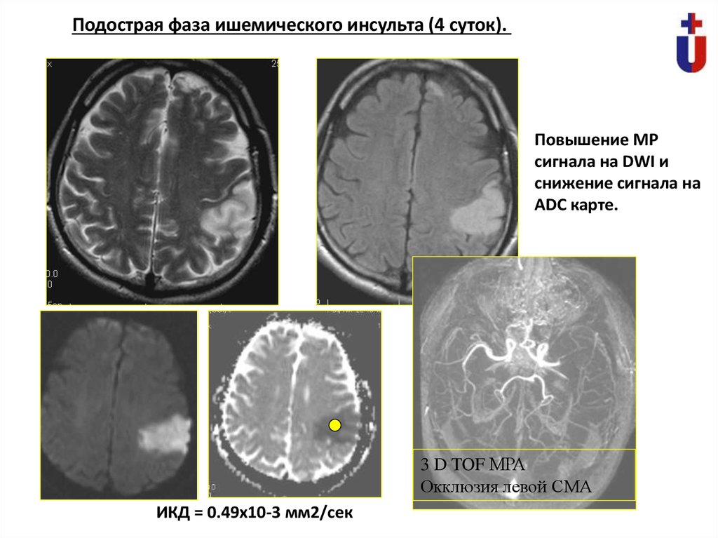 Карта adc мрт