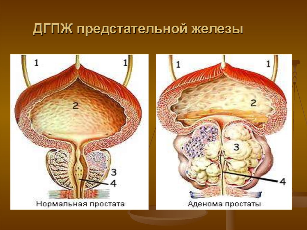 Гиперплазия предстательной железы 1