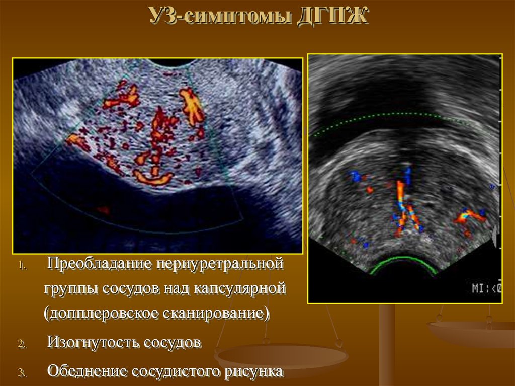 Гиперплазия предстательной железы 1. Гиперплазия предстательной железы УЗИ. УЗИ доброкачественная гиперплазия предстательной железы. Аденома предстательной железы на УЗИ.
