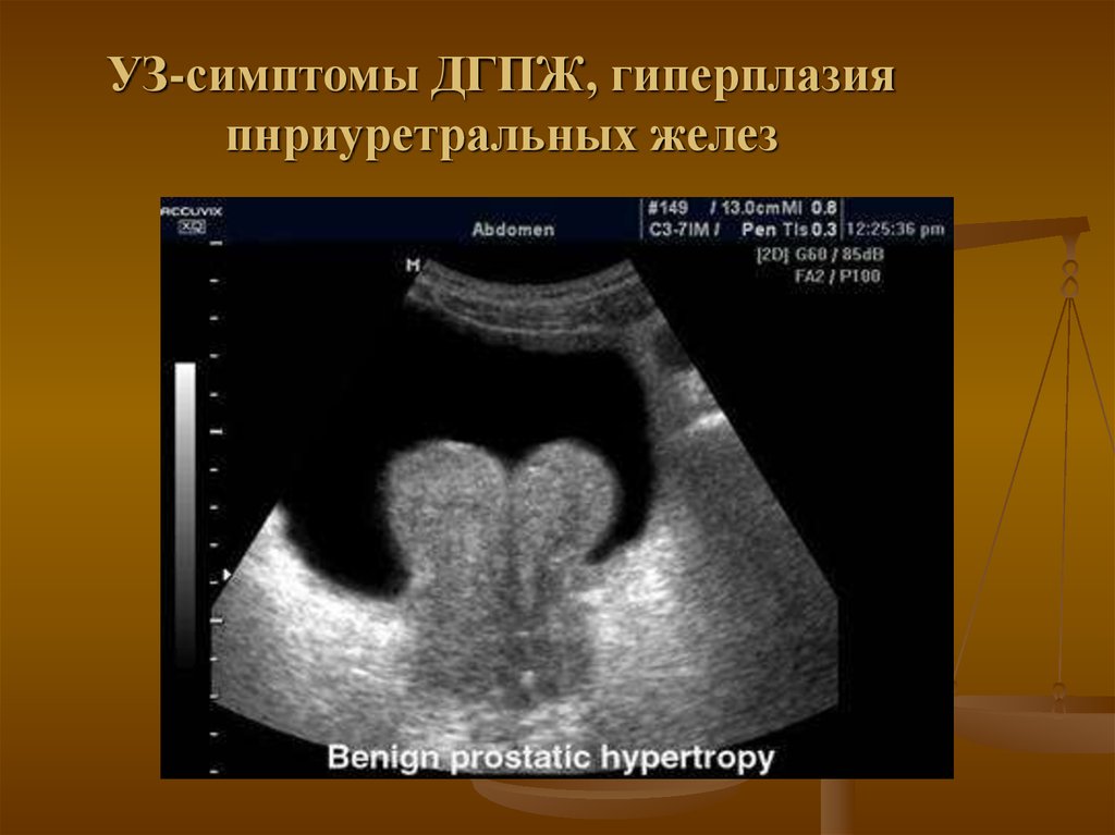 Что значит дгпж. Гиперплазия предстательной железы по УЗИ. Степени гиперплазии предстательной железы по УЗИ. УЗИ при гиперплазии предстательной железы.