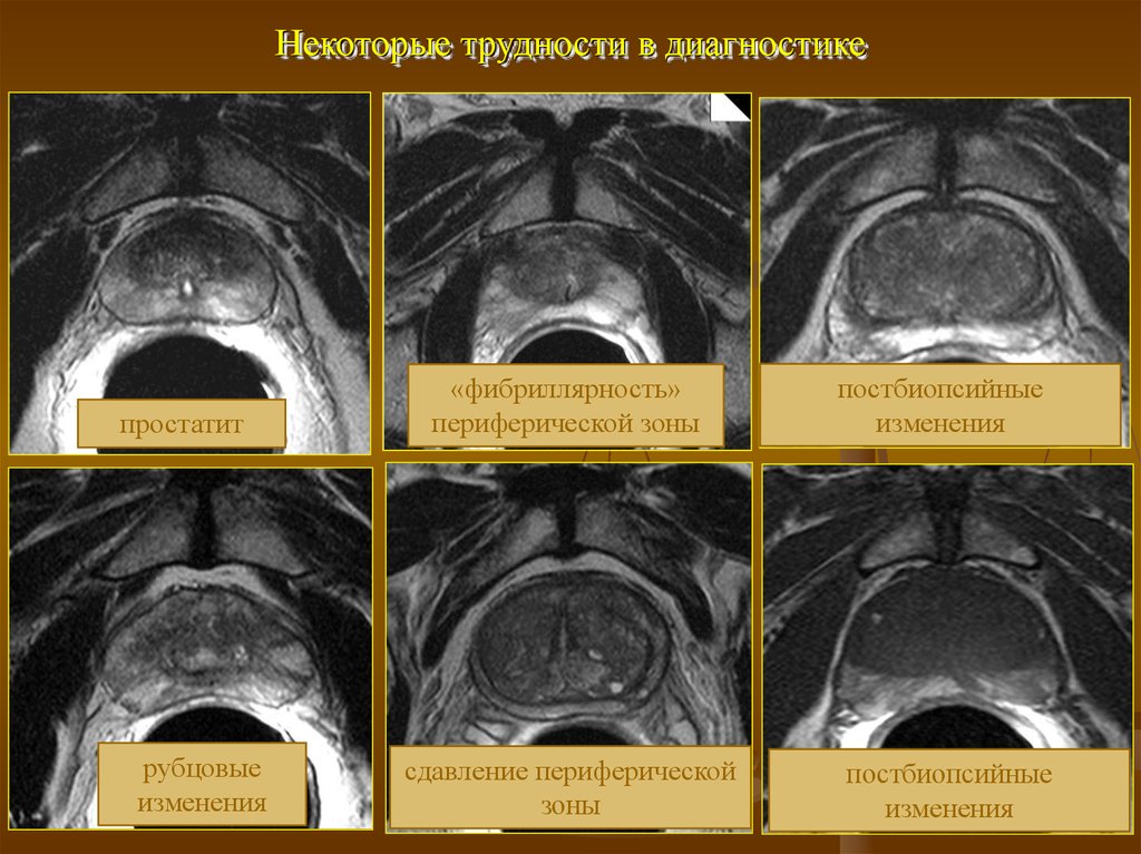 Очаговые изменения предстательной железы. Кисты предстательной железы мрт. Кисты в предстательной железе на мрт. Зоны предстательной железы мрт. Аденома предстательной железы мрт.