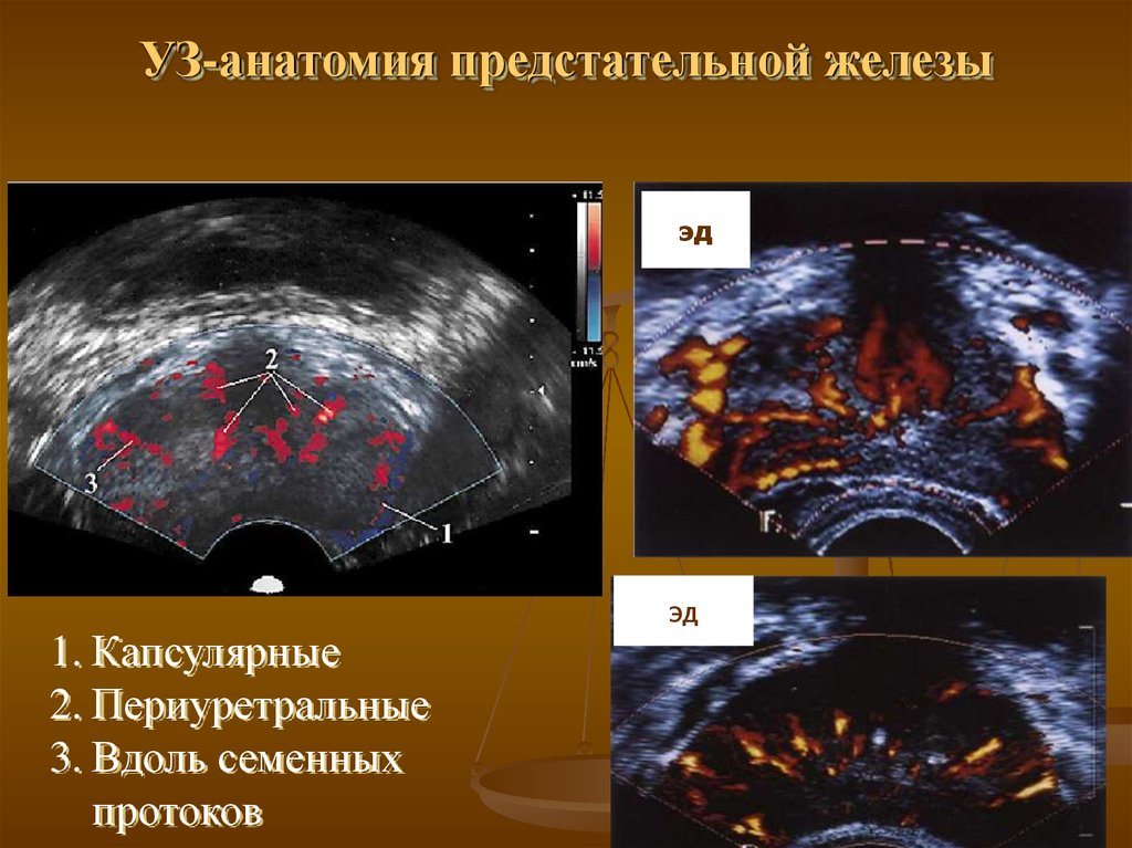 Простой предстательной железы. Анатомия предстательной железы на УЗИ трансабдоминально. Анатомия предстательной железы на УЗИ. Зоны предстательной железы на УЗИ. Ультразвуковая анатомия предстательной железы.