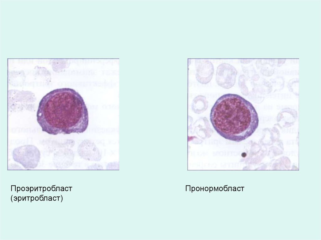 Нормоцит это. Базофильный эритробласт ядро. Оксифильный эритробласт. Базофильный нормоцит. Полихроматофильный эритробласт.