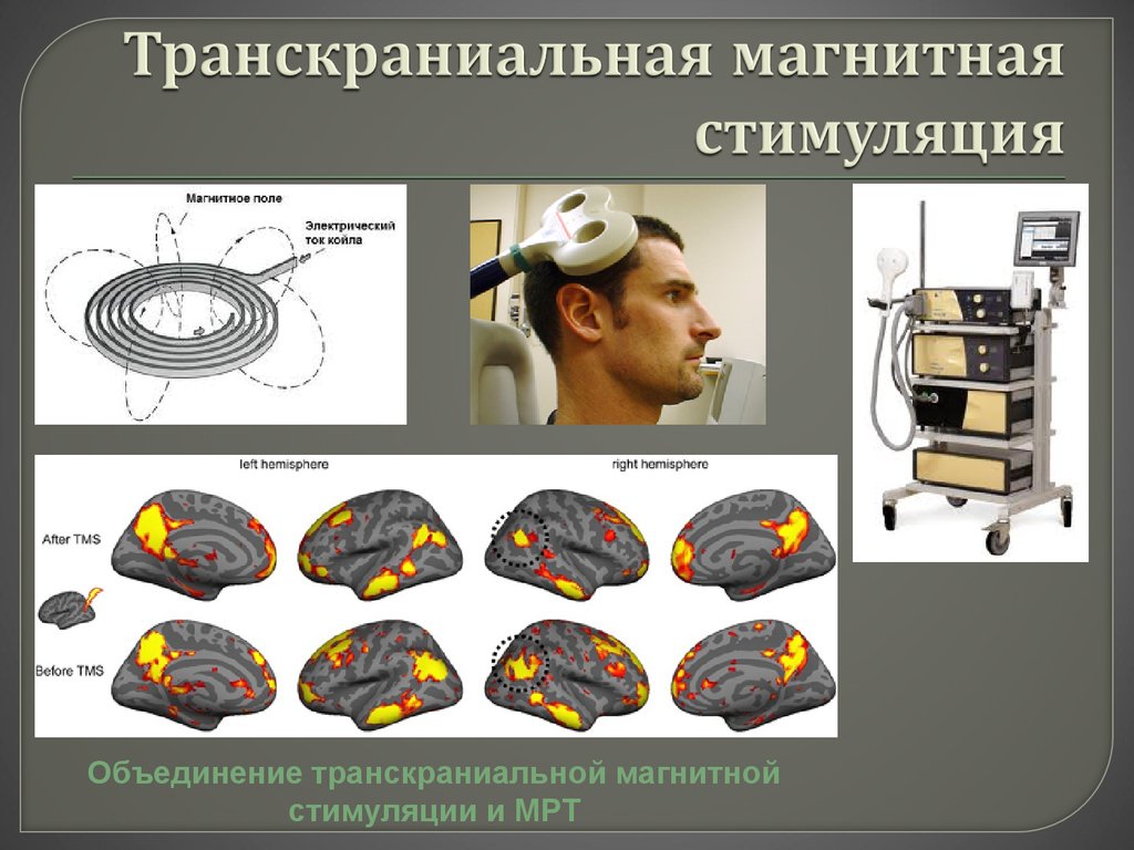Мозг магнитное поле. Транскраниальная магнитная стимуляция. Транскраниальный магнитный стимулятор. Аппарат транскраниальной магнитной стимуляции. Транскраниальная магнитная стимуляция (ТКМС).