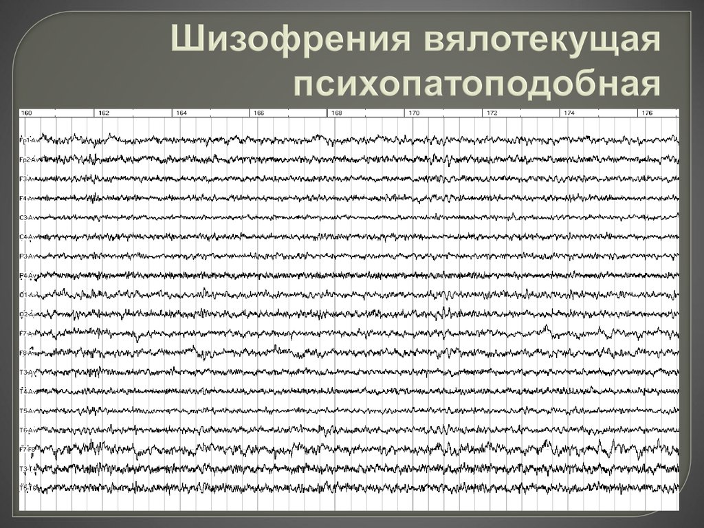 Вялотекущая шизофрения. Вялотекущая психопатоподобная шизофрения. Вяло Текущая Шизофрени. Вяло текущяя шизофрения.