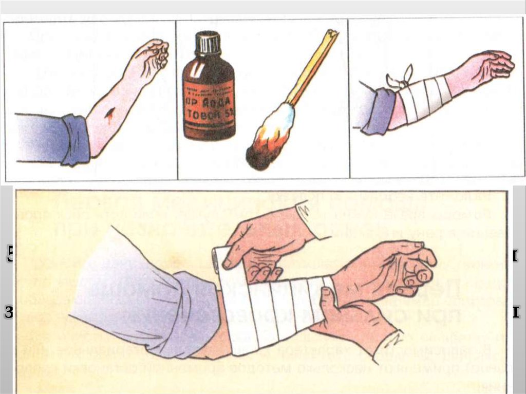 Раны обработка ран. ПМП при капиллярном кровотечении. Капиллярное кровотечение алгоритм оказания первой помощи. Алгоритм оказания ПМП при капиллярном кровотечении. Остановка капиллярного кровотечения.