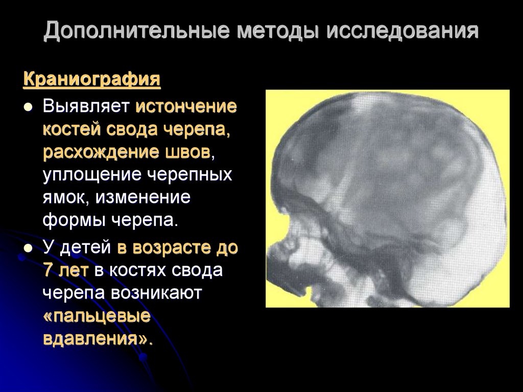 Рисунок пальцевых вдавлений и сосудистых борозд усилен