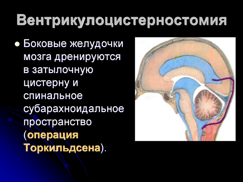 Гидроцефалия шунтирование мозга. Вентрикулоцистерностомия дна третьего желудочка. Торкильдсену вентрикулоцистерностомия. Желудочки головного мозга при гидроцефалии. Эндоскопическая вентрикулостомия III желудочка.