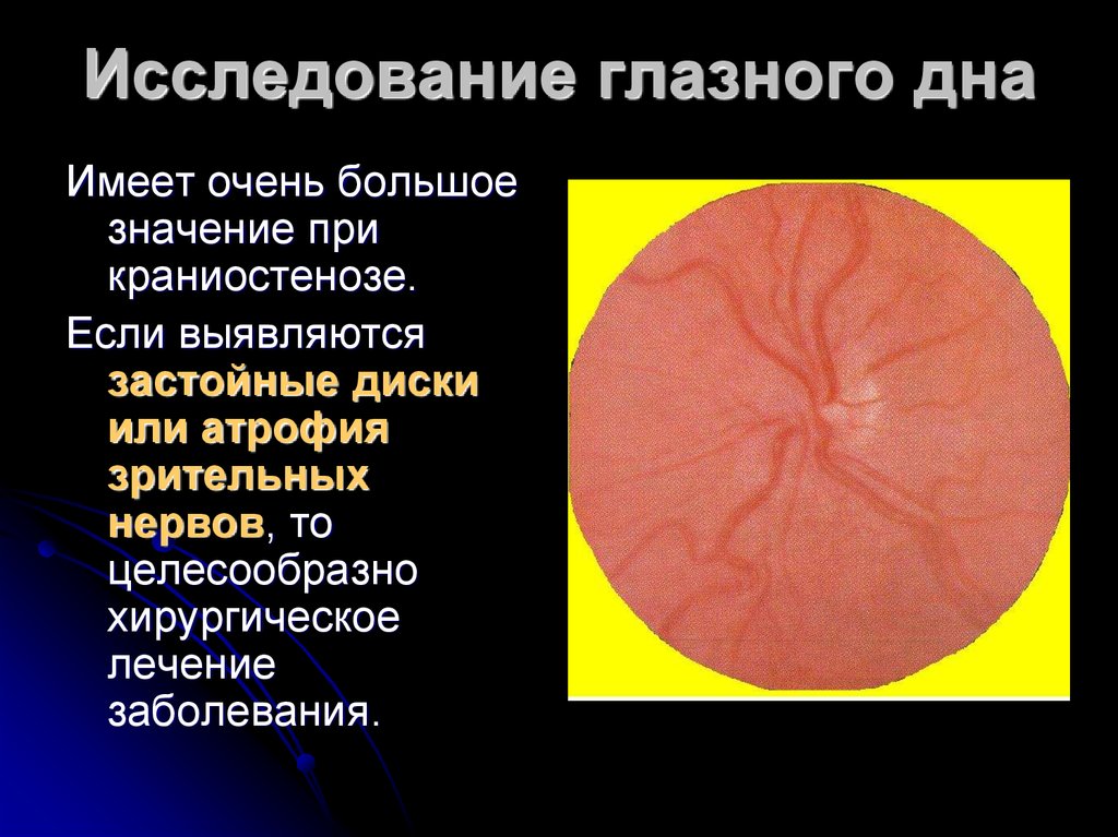 Исследование дна. Исследование глазного дна. Исследование дна глаза. Исследование состояния глазного дна. Глазное дно при гидроцефалии.