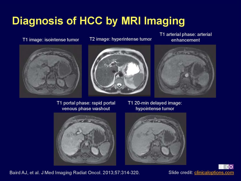 Diagnosis of HCC by MRI Imaging