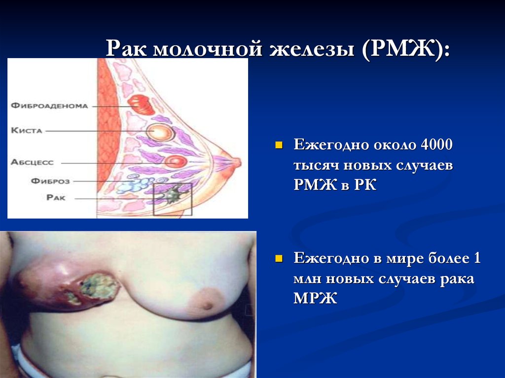Рак молочной железы (РМЖ):