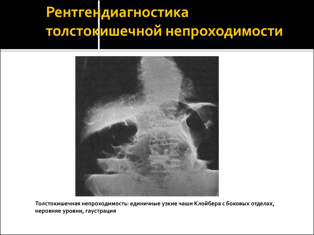 Помощь при кишечной непроходимости