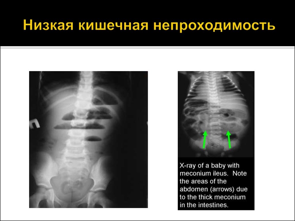 При непроходимости кишечника стул