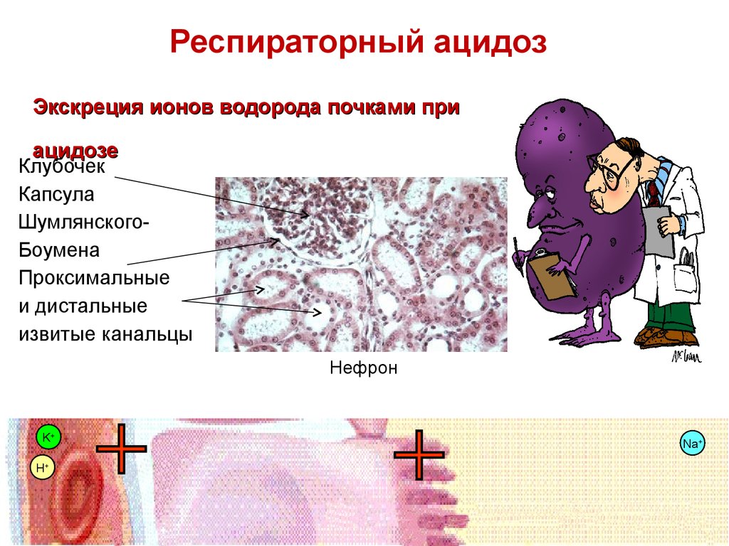 Ацидоз легких. Респираторный ацидоз. Дыхательный ацидоз. Хронический респираторный ацидоз. Хронический дыхательный ацидоз.