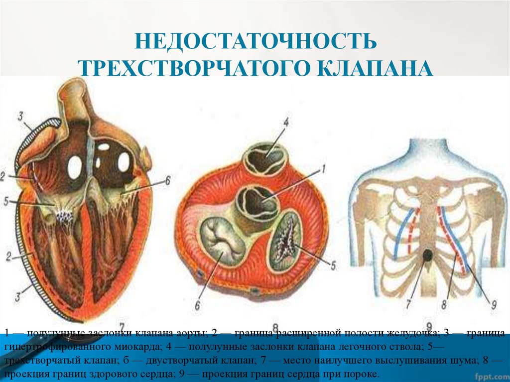 Трикуспидальный клапан. Недостаточность 3-х створчатого клапана. Порок сердца недостаточность трехстворчатого клапана. Недостаточность митрального и трехстворчатого клапанов. Недостаточность трехстворчатого клапана аускультация.