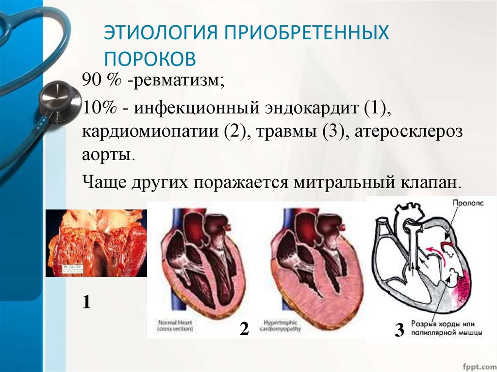 Приобретенные сердца. Приобретенный ревматический порок сердца. Приобретенные клапанные пороки сердца. Основная причина приобретённых пороков. Этиология и патогенез приобретенных пороков сердца.