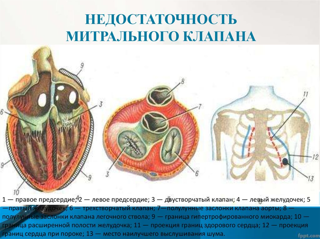 Сочетанный порок митрального клапана презентация