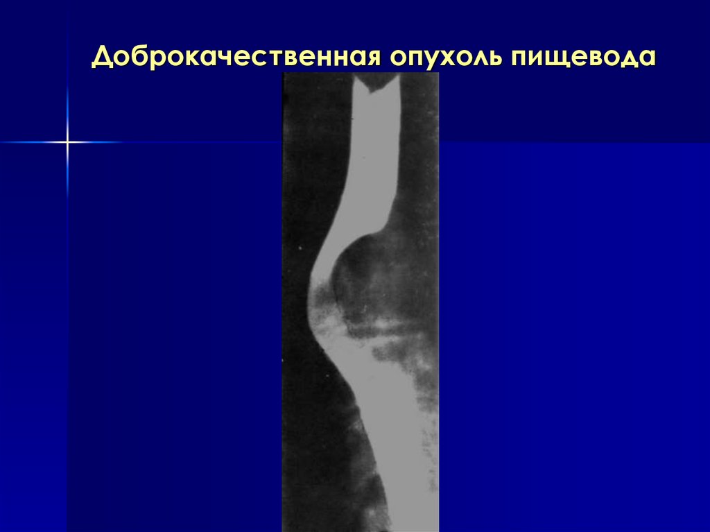 Доброкачественные опухоли презентация