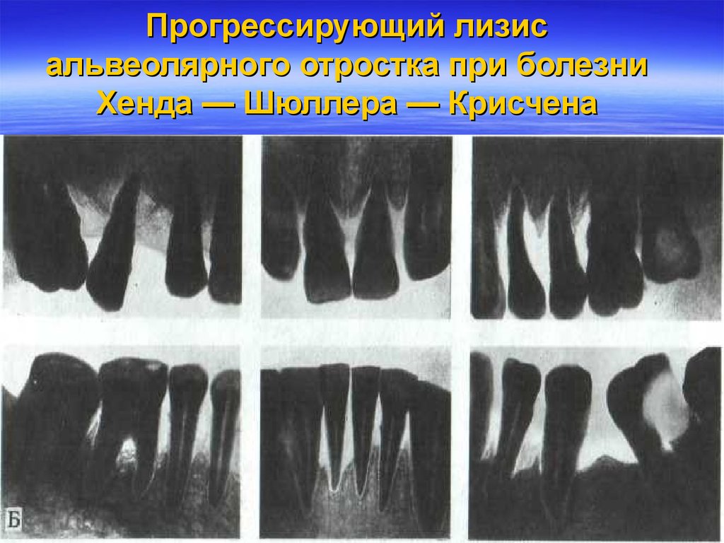 Синдром папийона. Болезнь хенда Шюллера Крисчена. Папионе лефера синдром. Синдром папийоли- лифера.