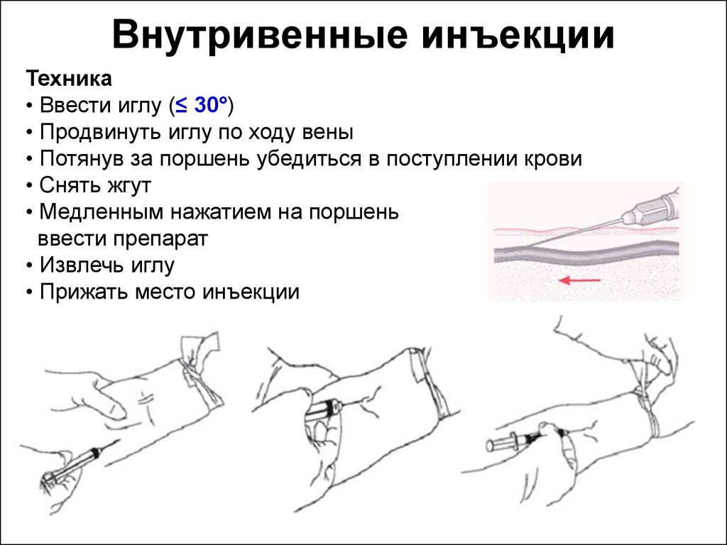 Как правильно держать шприц при внутривенной инъекции фото