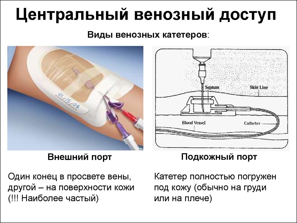 Места постановки периферического катетера. Центральный и периферический катетер. Внутривенный катетер алгоритм. Peripheral венозный катетер.