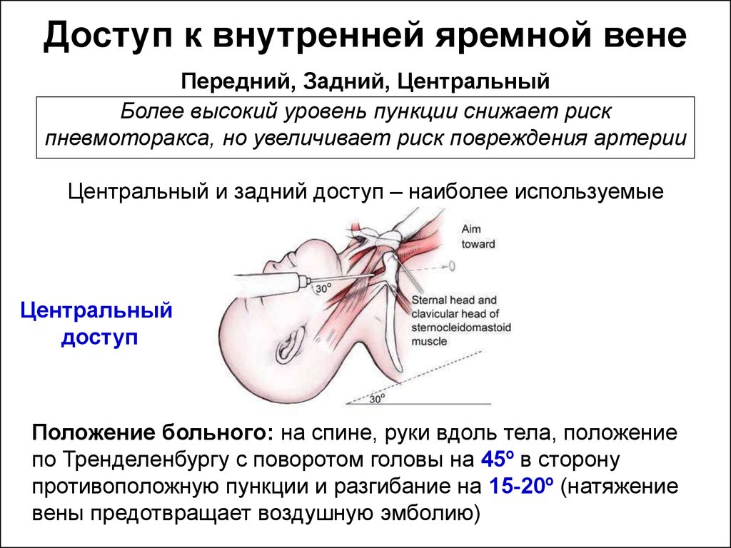 Катетеризация внутренней яремной вены схема