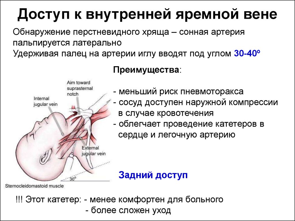 Катетер в яремной вене. Катетеризация подключичной яремной вены. Катетеризация и пункция центральных вен. Малая хирургическая манипуляция. Пункция и катетеризация наружной яремных вен..