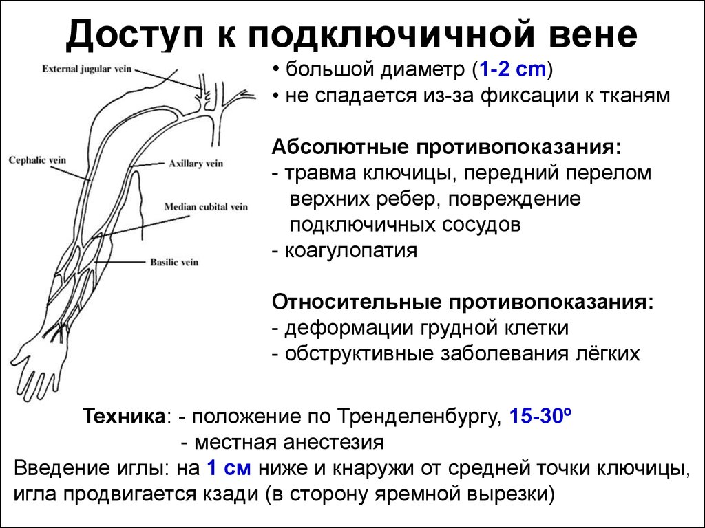 Подключичных вен. Доступ к подключичной артерии. Доступы к подключичной Вене. Расположение подключичных вен. Катетеризация плечевой артерии.