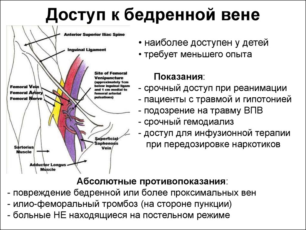 Катетеризация бедренной. Методы катетеризации бедренной вены. Бедренная Вена катетеризация ориентиры. Постановка катетера в бедренную Вену. Пункция бедренной вены схема.