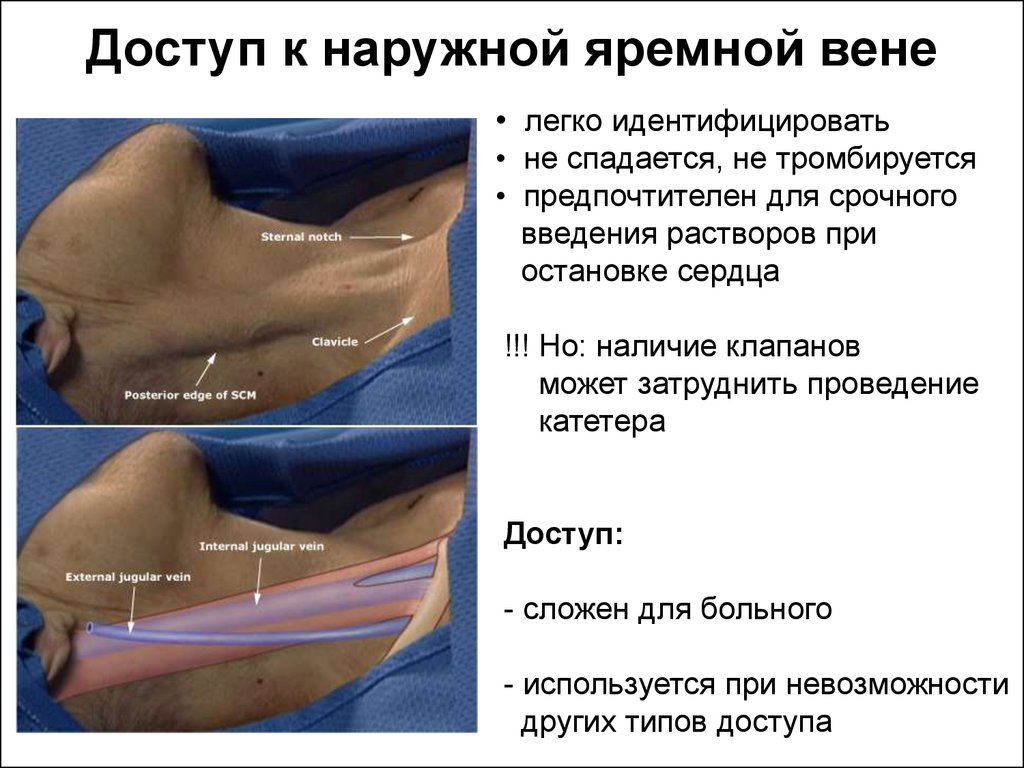 Катетер в яремную вену. Малая хирургическая манипуляция.